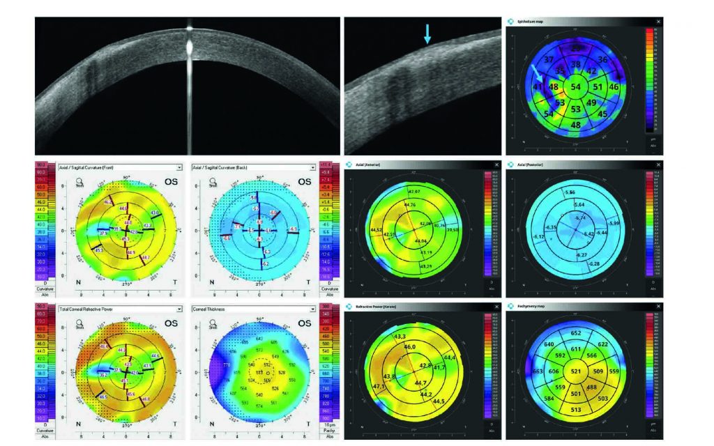 Simultaneous Corneal Topography and Epithelial Thickness Mapping from a Single Measurement Using Optical Coherence Tomography